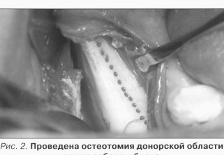 Клинико-морфологические результаты восстановления альвеолярных дефектов с применением кортикальных нижнечелюстных трансплантатов из ретромолярной области. (Жданов Е.В., Берченко Г.Н.)