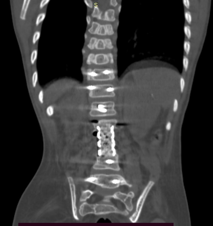 Spina Bifida